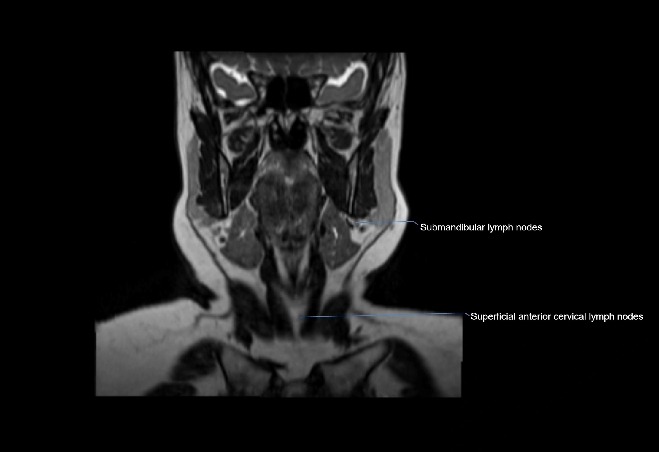 Neck coronal lymph node cross sectional MRI anatomy 3T MRI  image-img-00001-00048.webp